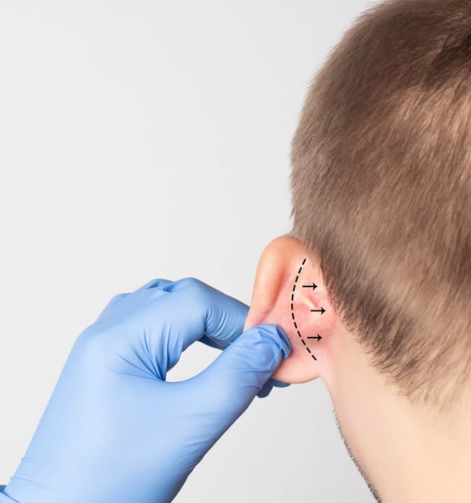 Otoplastika – Operácia uší